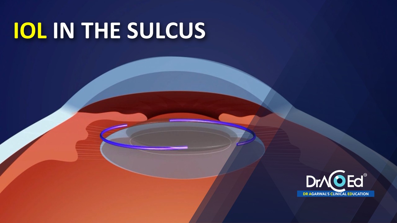 IOL IN THE SULCUS